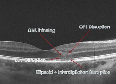 Paracentral Scotoma - Outlook Eye Specialists