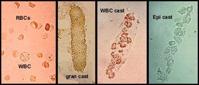 some casts found in urine | Medical Laboratories | Medical laboratory, Medical technology labs ...