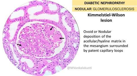 Diabetic Nephropathy | Pathology Made Simple