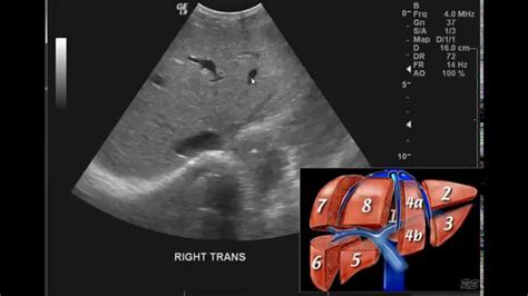 Introduction to the interpretation of Abdominal Ultrasound - YouTube