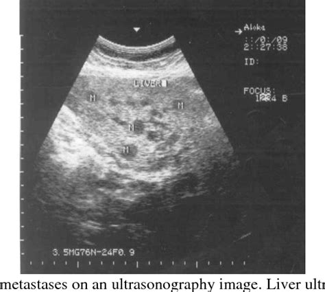 Figure 1 from Ultrasonography Appearances of Hepatic Metastases from ...