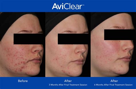 AviClear Treatment in Philadelphia | AviClear for Acne