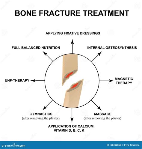 Treatment Of Bone Fractures. Bone Fracture With Displacement ...