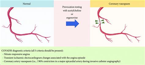 Coronary Vasospasm Provocation Testing and COVADIS diagnostic criteria ...