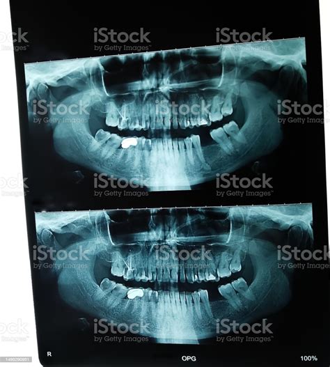 Dental Xray Orthopantomography Or Opg Stock Photo - Download Image Now ...