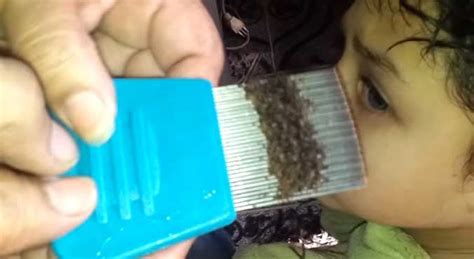 Going viral: An extreme head lice infestation video