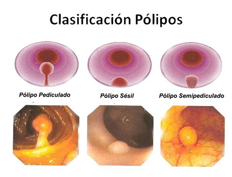 Polipos Endometriales - Dr. Jeronimo Amado