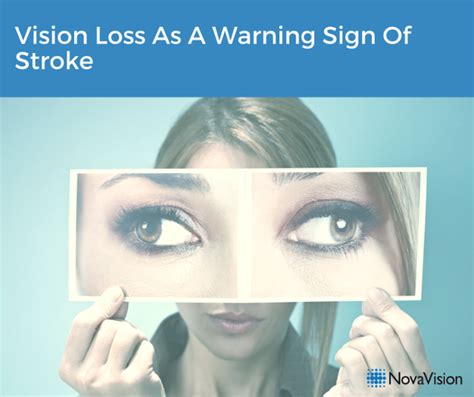 Vision Loss As A Warning Sign Of Stroke – NovaVision