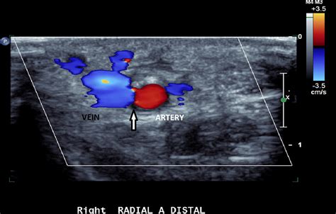 Arteriovenous Fistula as a Rare Early Complication of Transradial Coronary Angiography: With ...