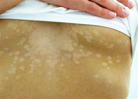 Home Remedies for White Patches and Skin Spots (Tinea Versicolor) | RemedyGrove