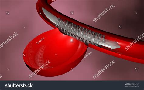 Aneurysm, Endovascular Treatment, Stent Stock Photo 179184923 : Shutterstock