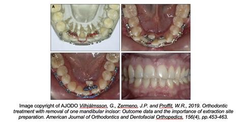 Lower incisor extraction in orthodontics: Dastardly or excellence? - Orthodontics in Summary
