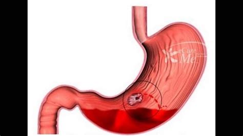 Upper Gastrointestinal Bleeding - Cause and Management - YouTube