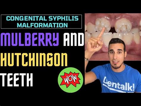 Hutchinson Teeth: Symptoms & Treatments