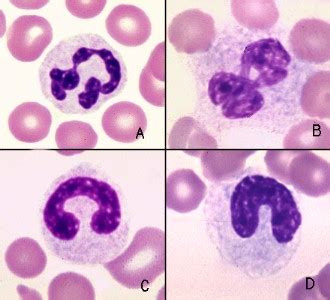 Normal neutrophils and neutrophils with toxic change | eClinpath