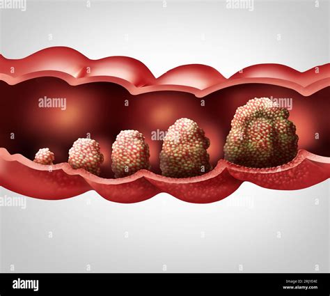 Cancer Stages Prognosis and Tumor progression Metastasis Colon or colorectal cancer concept as a ...