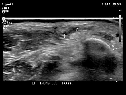 Stener lesion | Radiology Case | Radiopaedia.org