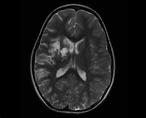 Axial MRI image showing subcortical right middle cerebral artery stroke ...