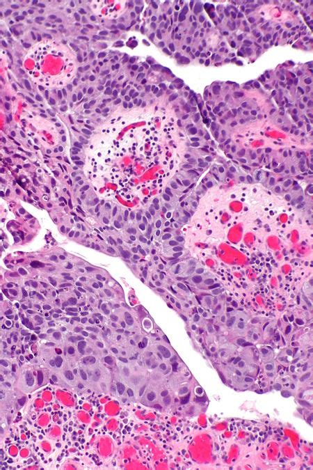 High-grade papillary urothelial carcinoma - Libre Pathology