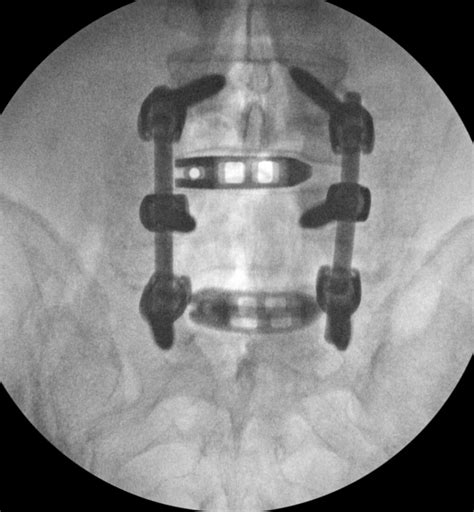 Transforaminal Lumbar Interbody Fusion (TLIF) - Lubbock, Amarillo ...