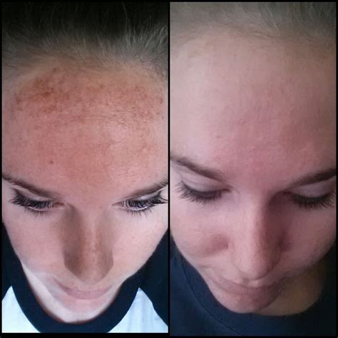 Ipl Face Treatment Before After - Doctor Heck