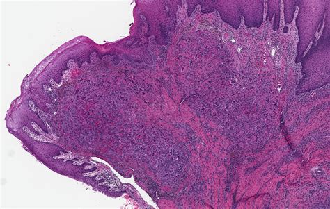 Central Giant Cell Granuloma Histology