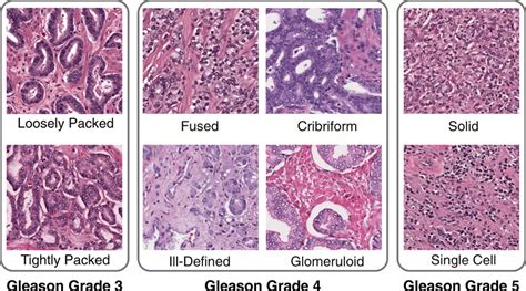 Key Common Architectures. Gleason grade 3 corresponds to Gleason 3... | Download Scientific Diagram