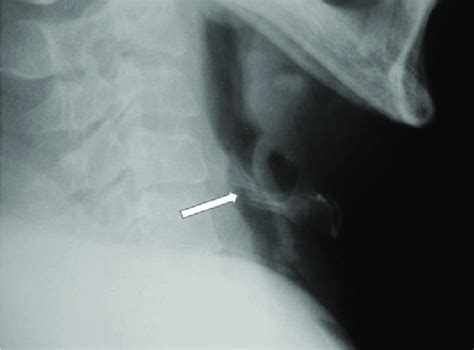 Hyoid Bone Injury