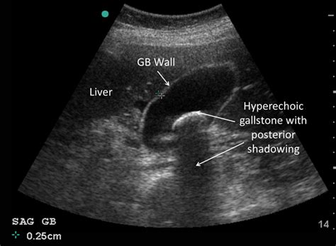 Will ultrasound show gallstones