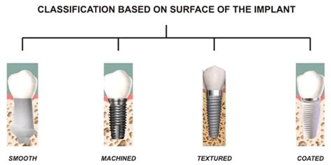 Types of Dental Implants by Sizes, Procedures and Materials