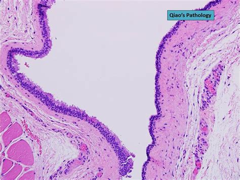 Branchial Cleft Cyst Histology