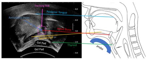 Hyoid Bone Ultrasound