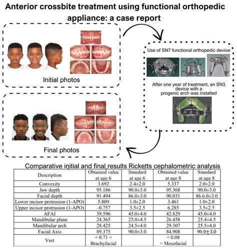 Anterior crossbite treatment using functional orthopedic appliance: a case report - Extrica