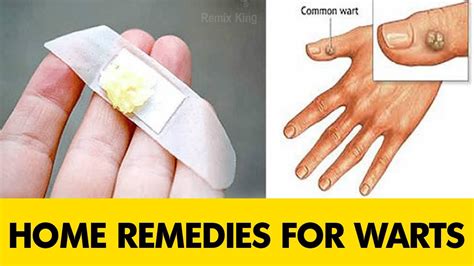 Genital warts home treatment - home remedies for warts || homeveda - YouTube