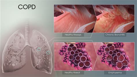 Types Of Copd Diseases