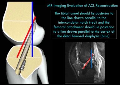 Dynamic Mri of ACL Reconstruction | coachingultrasound