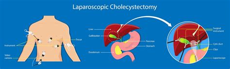 Real Psychiatry: The Laparoscopic Cholecystectomy