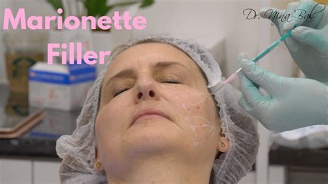 Filler Marionette Lines Before and After 💕 Dr. Nina Bal 💕 Facial ...