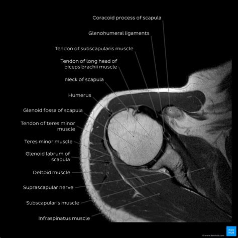 Shoulder Mri Normal Anatomy E Anatomy | Porn Sex Picture