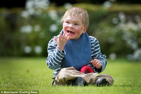 Teenage boy looks like a toddler thanks to rare syndrome | Daily Mail ...