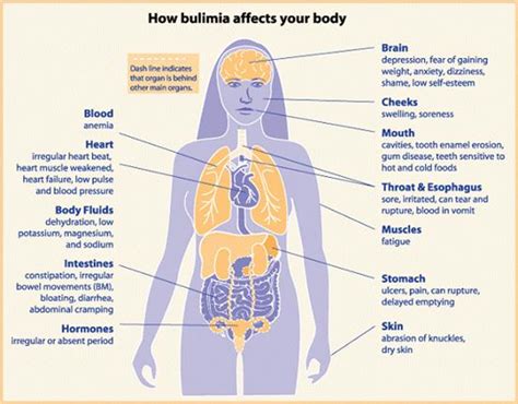 How Does Bulimia Impact The Brain: Unveiling The Neurological Effects