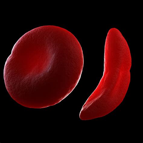 46+ Hydroxyurea Sickle Cell Anemia Treatment UK