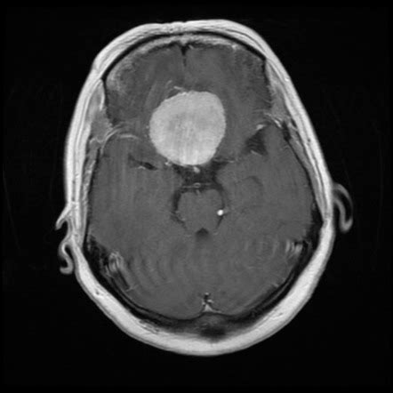 Planum sphenoidale meningioma | Image | Radiopaedia.org