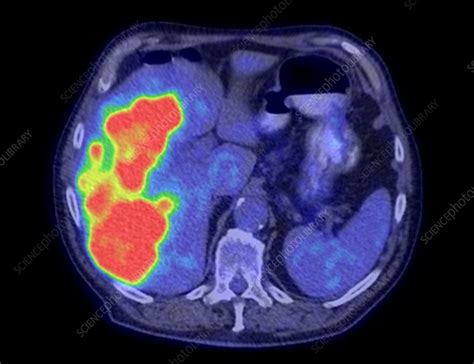 Secondary liver cancer, CT and PET scan - Stock Image - C039/0159 - Science Photo Library