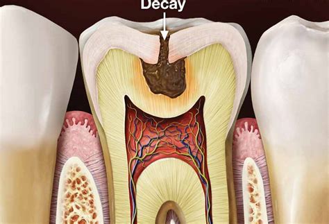 How to Stop Teeth Decay | MAC Dental