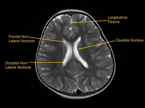 PPT - MRI of Brain/Head and Neck PowerPoint Presentation, free download - ID:601876