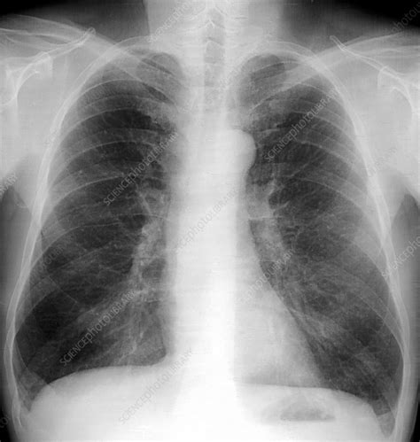 Smoker's lungs, X-ray - Stock Image C001/7637 - Science Photo Library