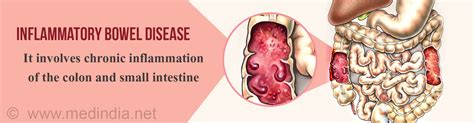 Inflammatory Bowel Disease - Causes, Symptoms, Diagnosis, Treatment & Prevention