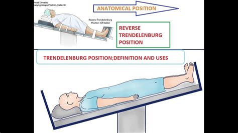 Trendelenburg Position Nursing