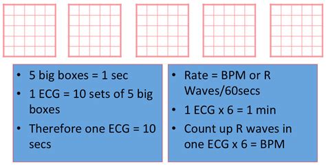 ECG Basics - R.E.B.E.L. EM - Emergency Medicine Blog